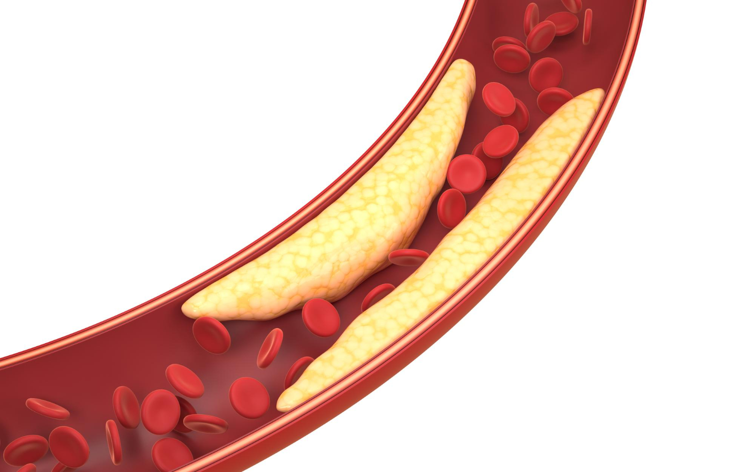 MTL ir DTL – blogasis ir gerasis cholesterolis kraujyje
